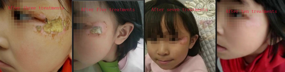 Facial Treatment Case-02